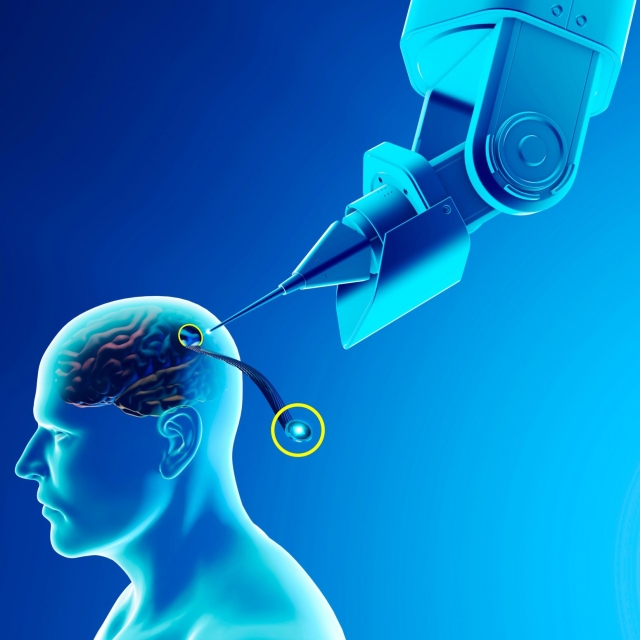 drawing of a robotic surgical tool implanting a device into a brain